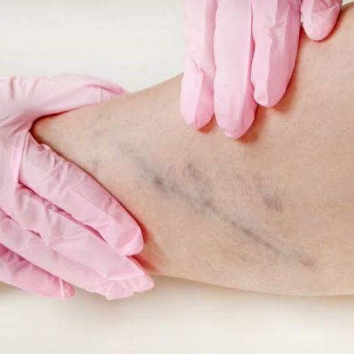 Agosto Azul Vermelho reforça prevenção das doenças vasculares no RN com ação de Check-up Vascular gratuito
