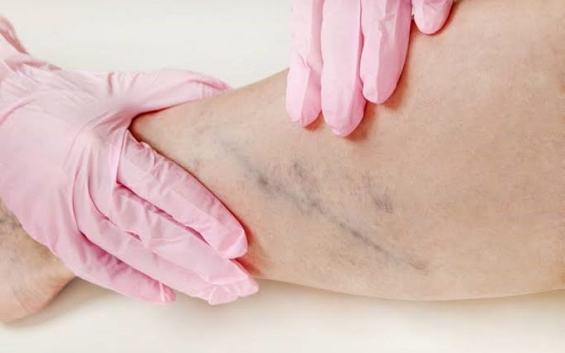 Agosto Azul Vermelho reforça prevenção das doenças vasculares no RN com ação de Check-up Vascular gratuito